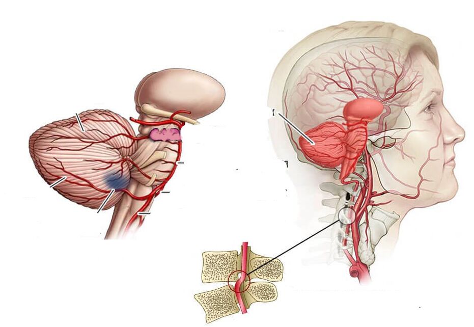Cerebellar iskemi